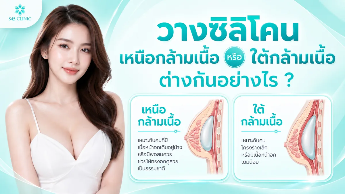 เสริมหน้าอก ดีไหม วางซิลิโคนเหนือกล้ามเนื้อหรือใต้กล้ามเนื้อต่างกันอย่างไร
