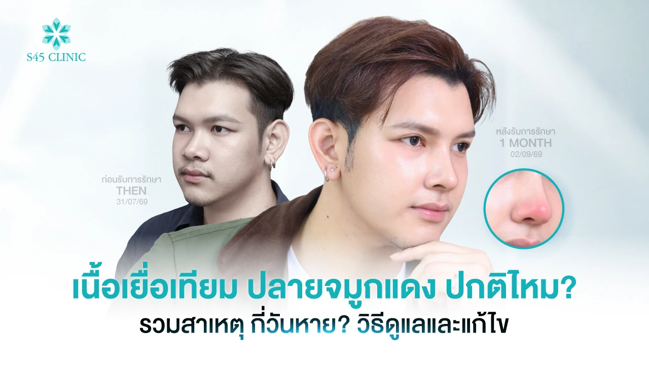ภาพผู้รับบริการชายก่อนเสริมจมูกและหลังทำ 1 เดือน กับภาพปลายจมูกแดง