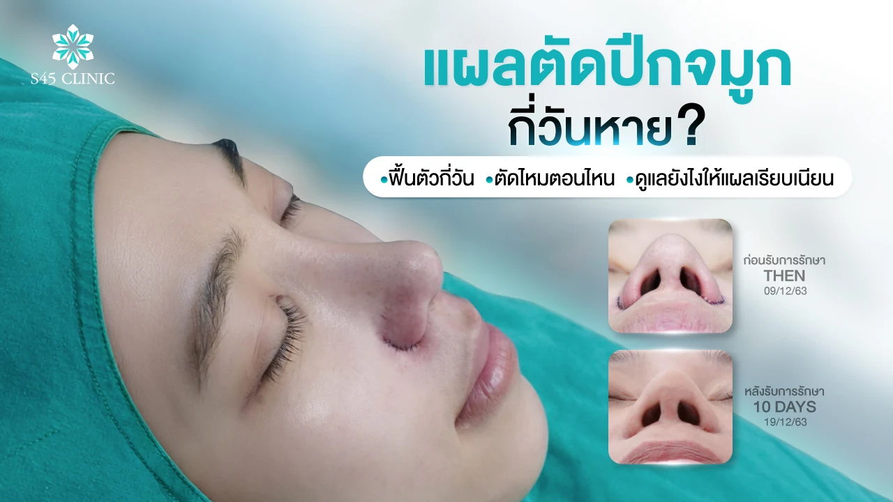 ผู้รับบริการหลังตัดปีกจมูก กับภาพรูจมูกก่อนทำและหลังทำ 10 วัน