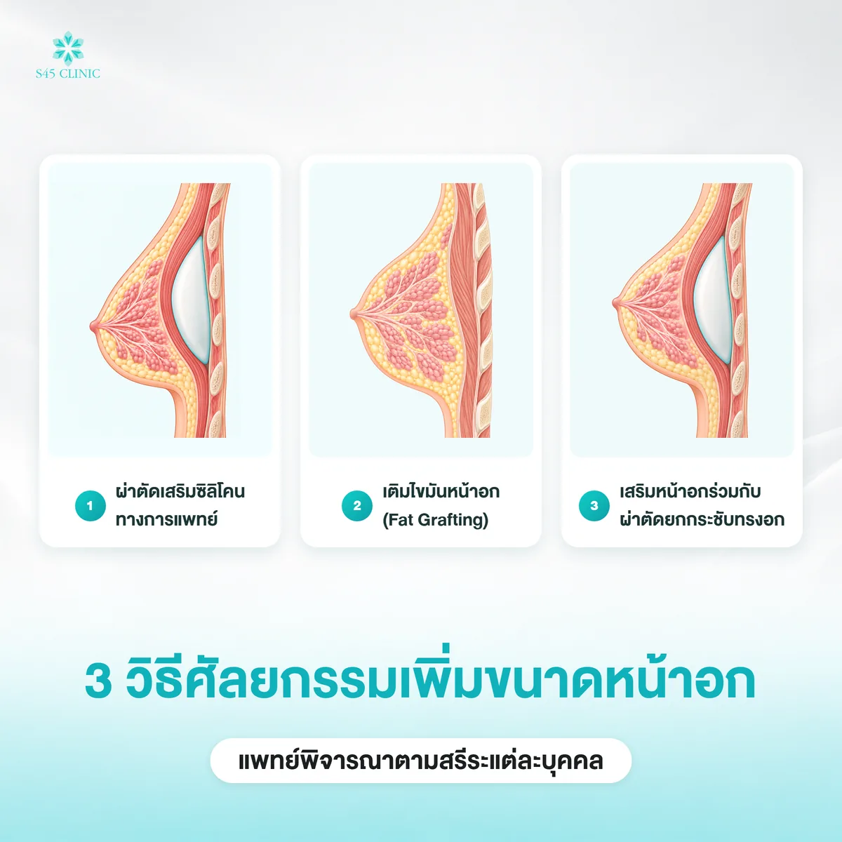 3 วิธีศัลยกรรมเพิ่มขนาดหน้าอก เสริมซิลิโคน เติมไขมัน และเสริมร่วมกับยกกระชับ