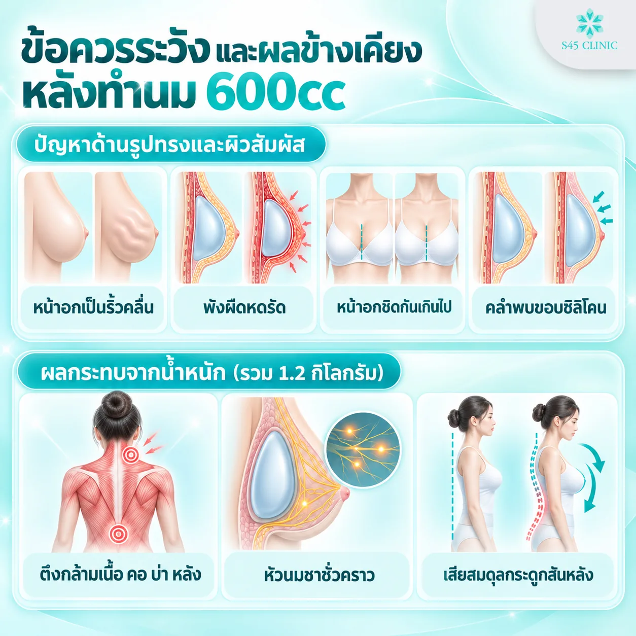 Infographic in Thai on precautions and side effects after 600cc breast implants, showing shape and skin problems (rippling, capsular contracture, breasts too close together and implant edges that can be felt) and the effects of the 1.2kg total weight (tight neck, shoulder and back muscles, temporary nipple numbness and changes in spine balance)