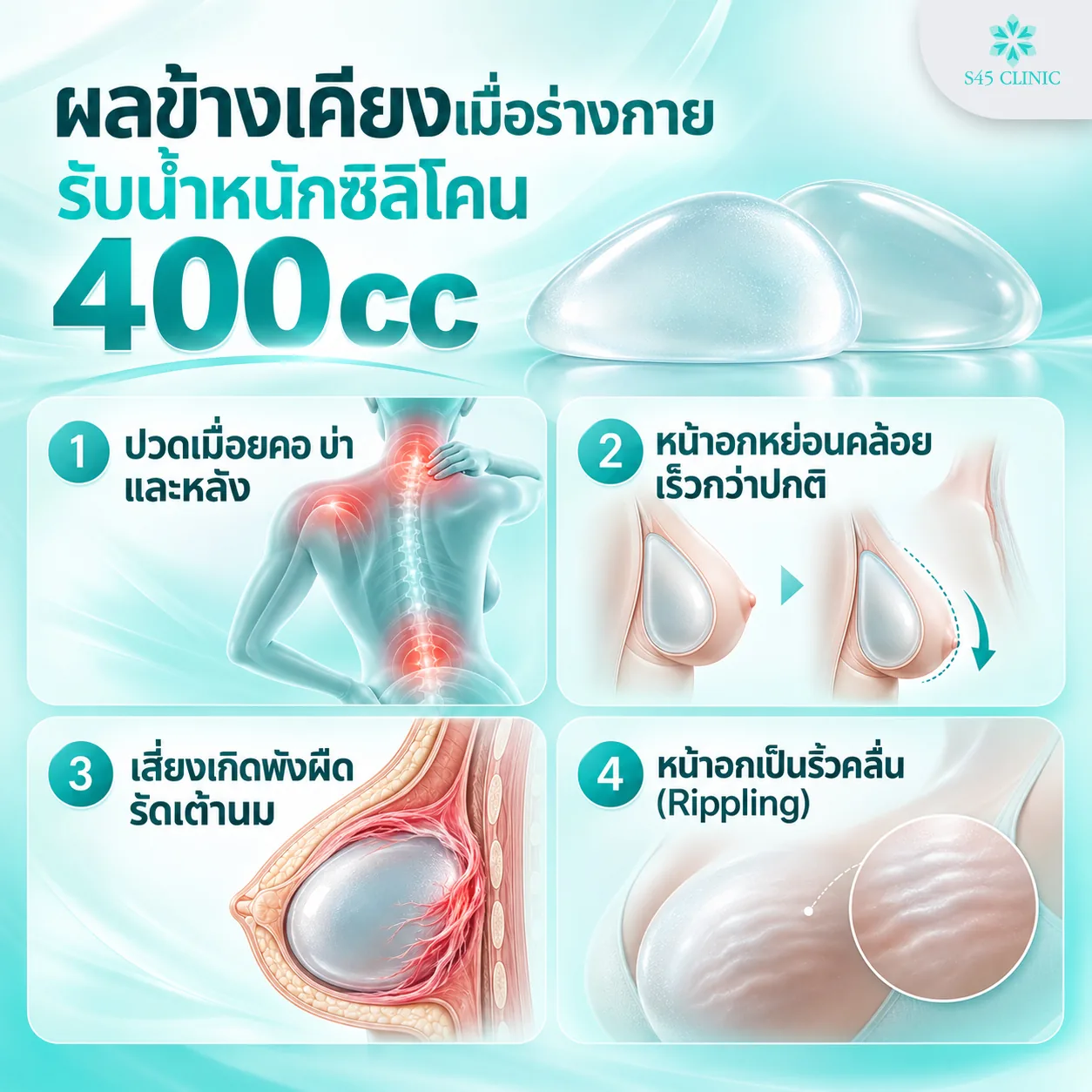 Infographic of 4 side effects of the weight of 400cc implants. 1, aches in the neck, shoulders and back. 2, breasts sagging sooner than usual. 3, a chance of capsular contracture, where scar tissue tightens around the implant. 4, rippling of the breasts