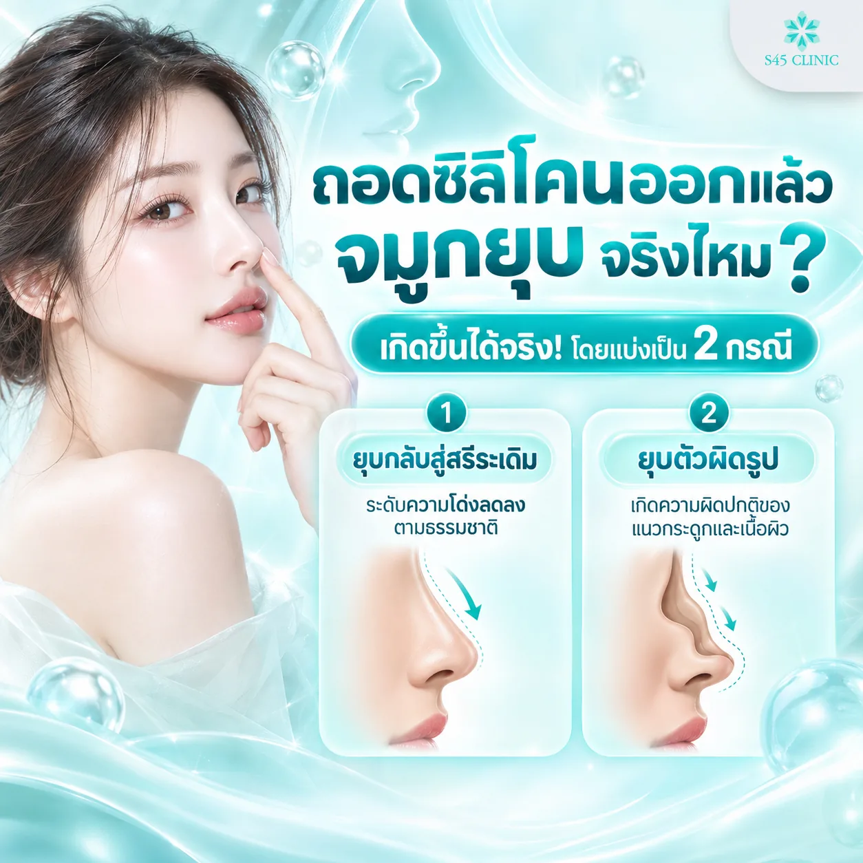 Infographic in Thai titled 'Is it true that the nose collapses after silicone implant removal?', saying it can happen in 2 ways, each shown with a side view of a nose: 1, the nose goes back down to its original shape, with its height lowering naturally, and 2, the nose collapses out of shape because of a problem with the bone and tissue framework