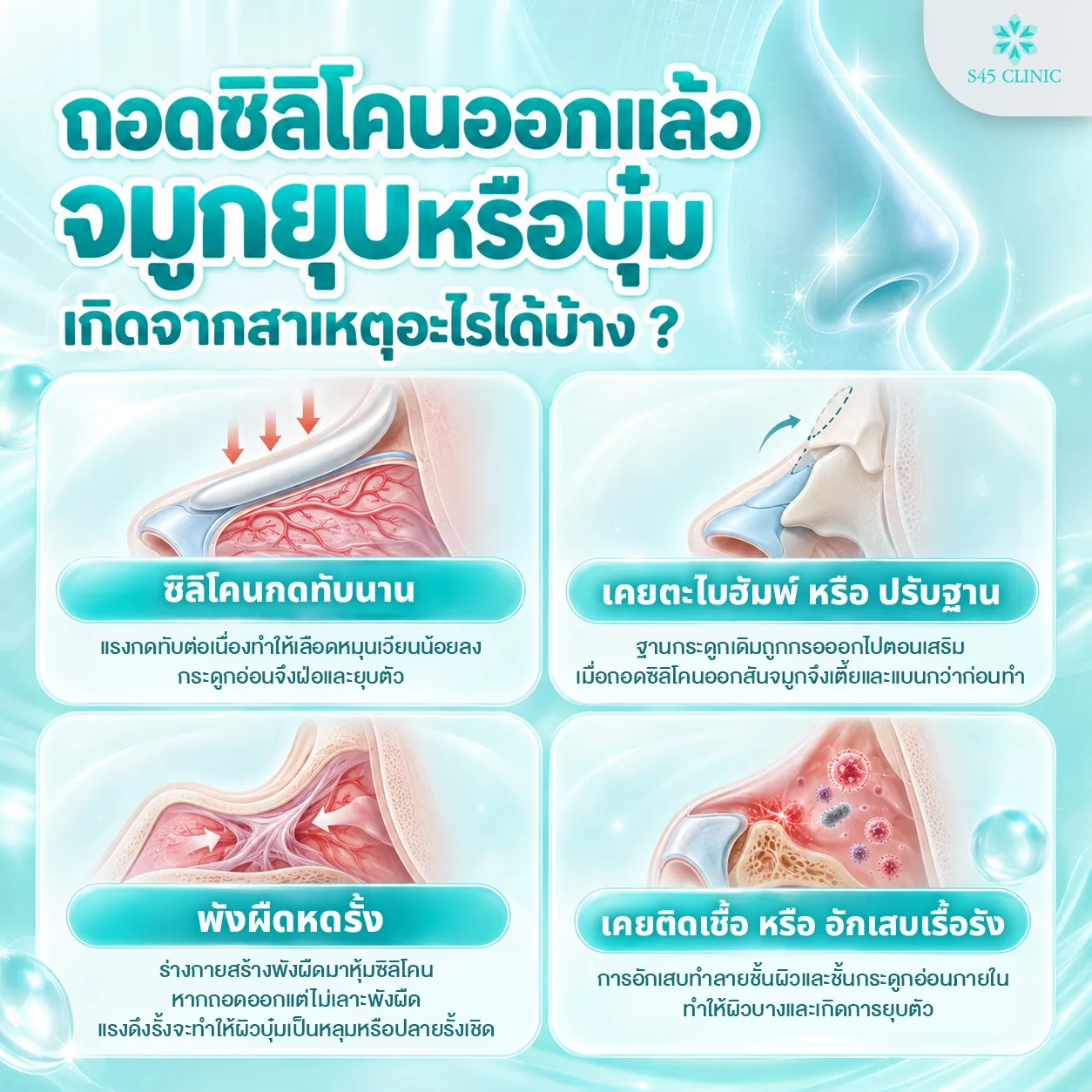Infographic in Thai titled 'What can cause a collapsed or dented nose after silicone implant removal?', with illustrations of the inside of the nose and 4 causes: long-term pressure from silicone, which reduces blood flow so the cartilage thins and collapses, a dorsal hump rasped or the base reshaped before, where bone was filed down during rhinoplasty so the bridge is lower and flatter than before once the silicone is removed, scar tissue tightening, where the body forms scar tissue around the silicone and, if it is not removed with the implant, it pulls the skin into a hollow or pulls the tip up, and a past infection or long-term inflammation, which damages the skin and inner cartilage so the skin thins and collapses