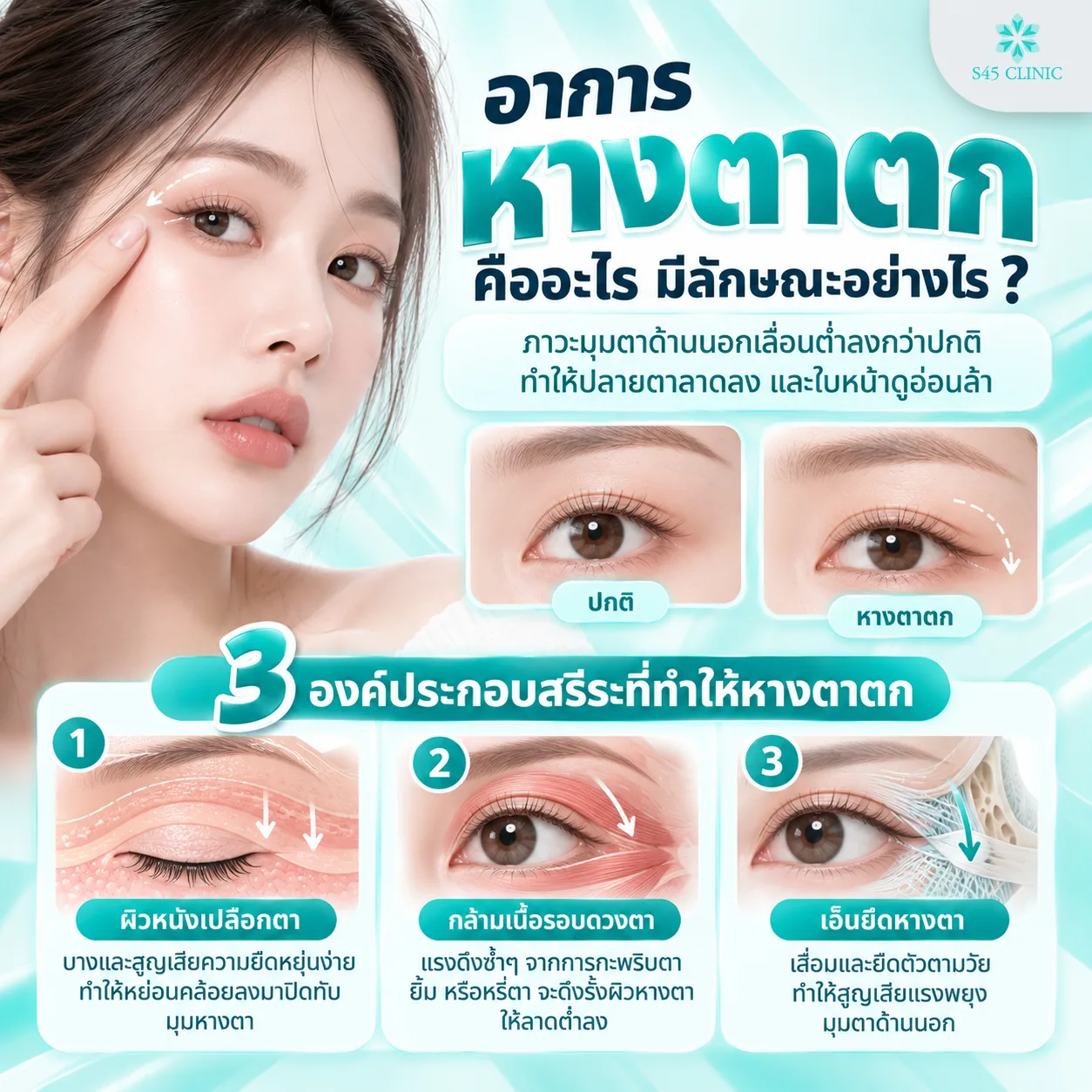 What droopy outer eye corners are: the outer eye corner sits lower than usual, so the end of the eye slopes down and the face looks tired. A normal eye is compared with a droopy outer eye corner, followed by 3 anatomical factors: thin eyelid skin that loses elasticity and sags over the outer eye corner, repeated pull from the muscle around the eye when blinking, smiling or squinting, and a tendon at the outer eye corner that stretches with age and loses support