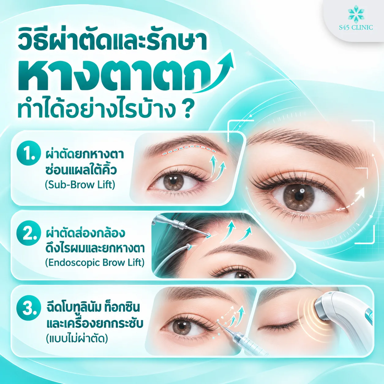 Ways to treat droopy outer eye corners: 1. a sub-brow lift that hides the scar beneath the eyebrow, 2. an endoscopic brow lift through the hairline that also lifts the outer eye corners, and 3. botulinum toxin injections and a skin-tightening device, without surgery