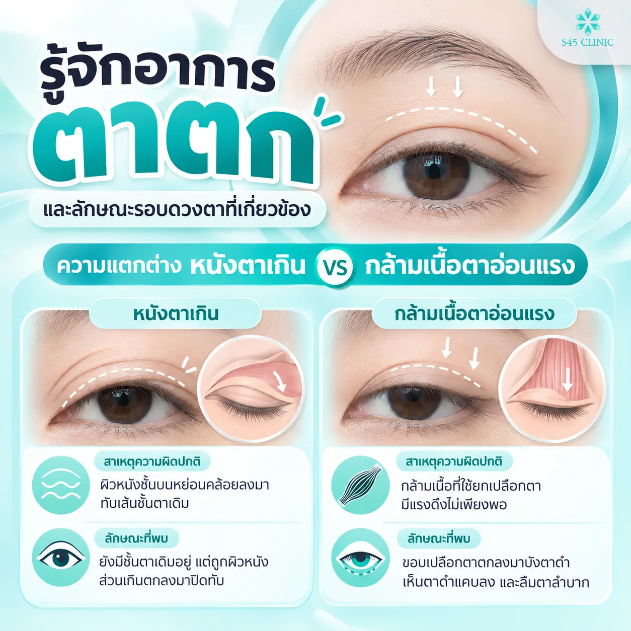 Infographic in Thai on understanding droopy eyelids and the difference between excess eyelid skin and ptosis: with excess skin, the upper skin sags over the existing eyelid crease, which is still there but covered; with ptosis, the muscle that lifts the eyelid is not strong enough, so the eyelid edge covers part of the iris, the visible iris looks smaller and the eye is hard to open