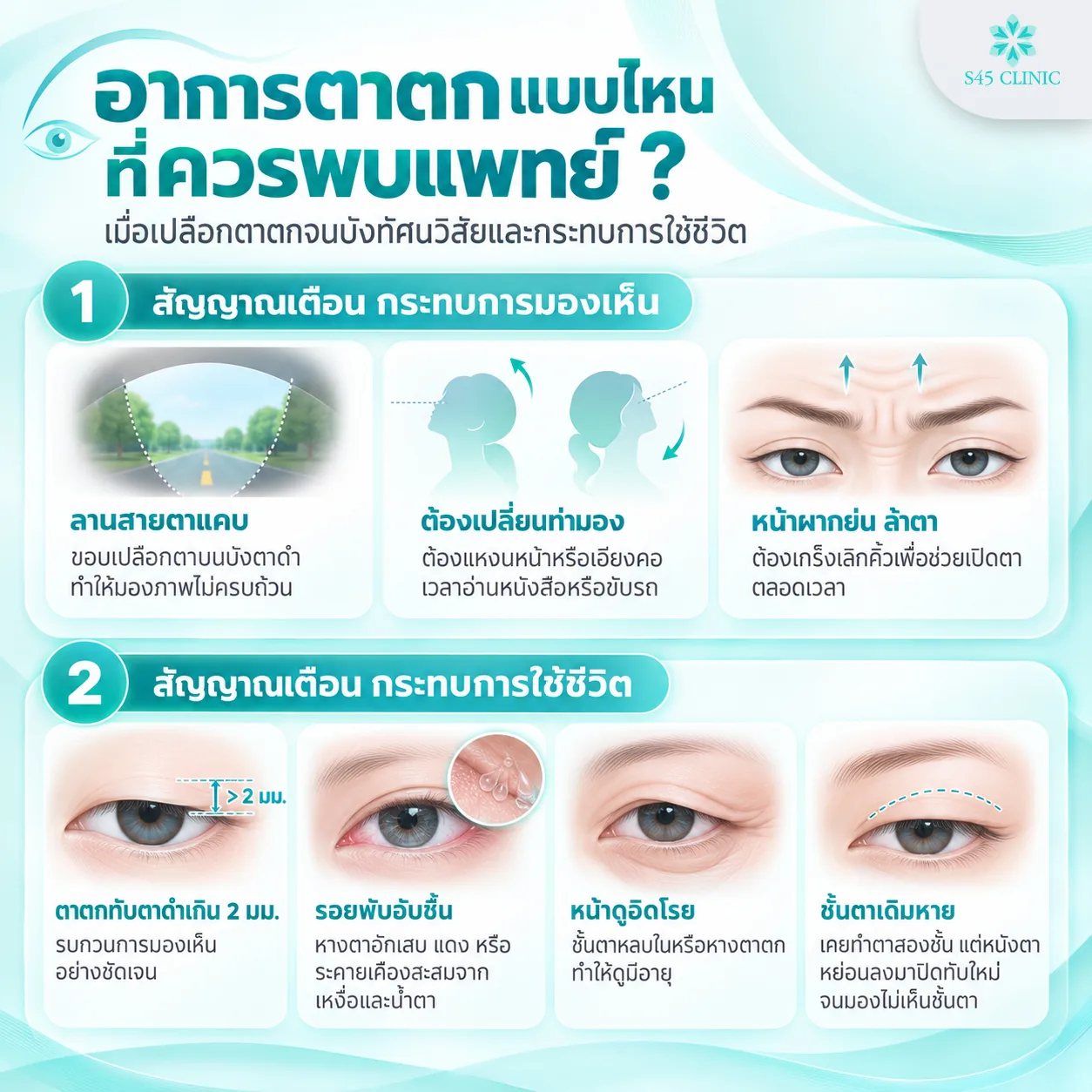Infographic in Thai on when to see a doctor about droopy eyelids, when the eyelid blocks your vision and affects daily life. Warning signs for vision: a narrower field of vision, needing to tilt your head back or to the side to read or drive, and a wrinkled, tired forehead from raising your eyebrows to open your eyes. Warning signs for daily life: the eyelid covering the iris by more than 2mm, irritation in the damp fold at the outer eye corner, a tired-looking face, and an eyelid crease from previous double eyelid surgery being covered again