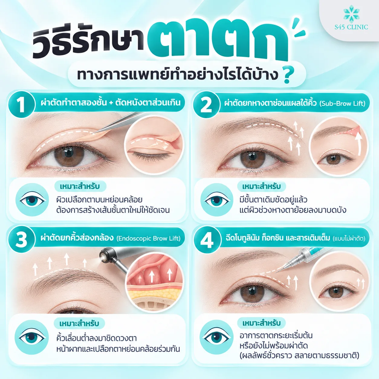 Infographic in Thai on 4 medical treatments for droopy eyelids and who each suits: double eyelid surgery with removal of excess skin, for sagging upper eyelid skin and creating a new clear crease; a sub-brow lift, for people with a clear existing crease and skin at the outer eye corner covering it; an endoscopic brow lift, for low eyebrows with a sagging forehead and eyelids; and botulinum toxin injections with filler injections without surgery, for early droopy eyelids or people not ready for surgery, with temporary results that the body breaks down over time