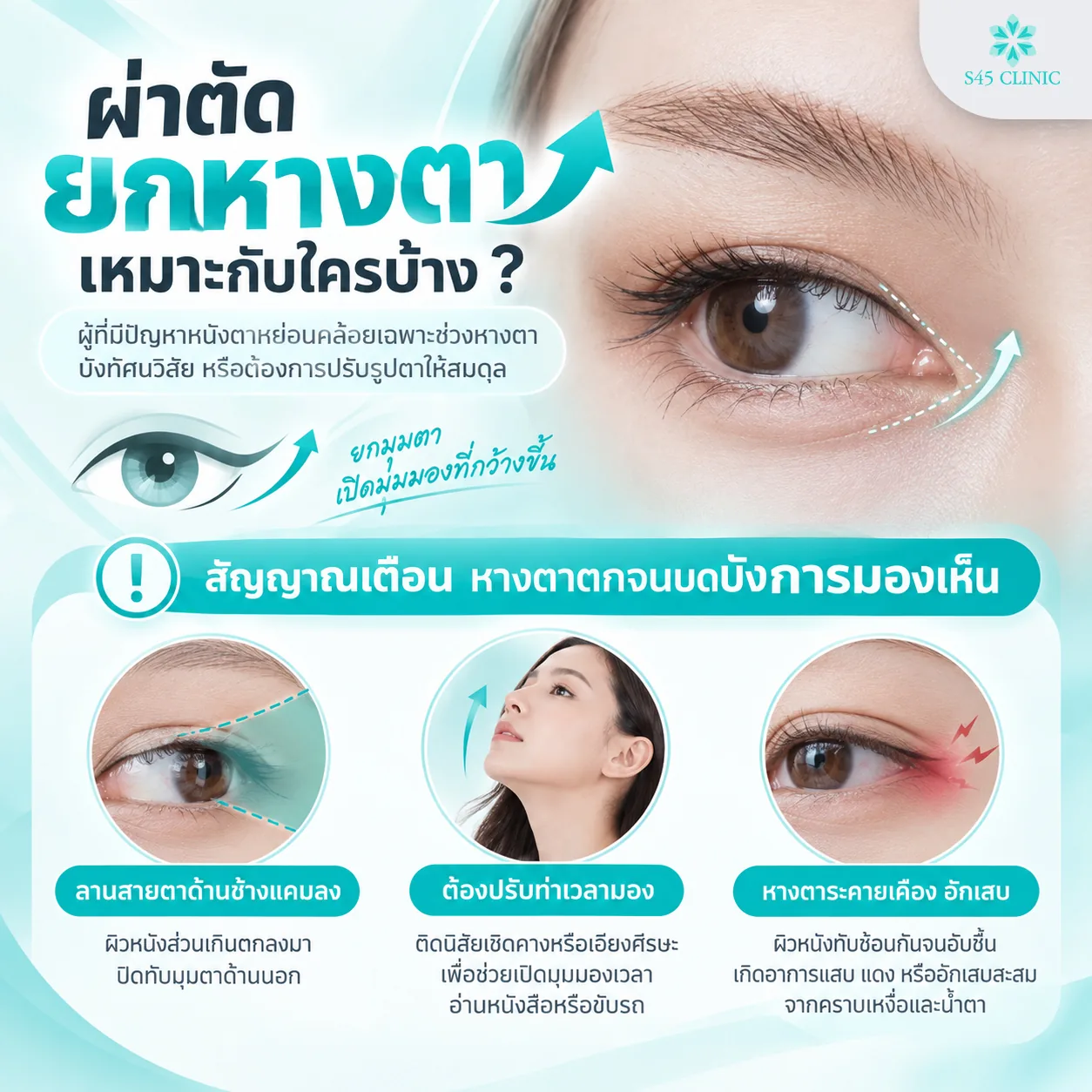ผ่าตัดยกหางตาเหมาะกับใคร และสัญญาณเตือนหางตาตกจนบดบังการมองเห็น