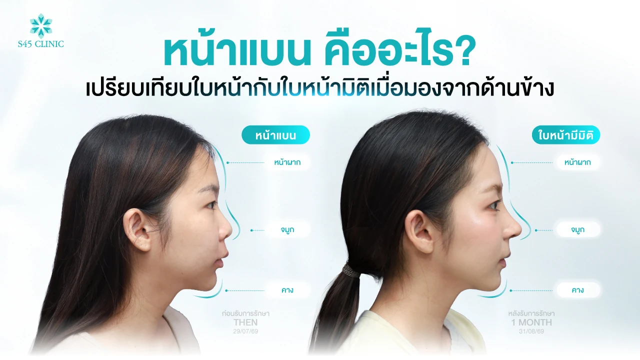 ภาพด้านข้างผู้รับบริการก่อนทำและหลังทำ 1 เดือน เปรียบเทียบหน้าผาก จมูก และคาง