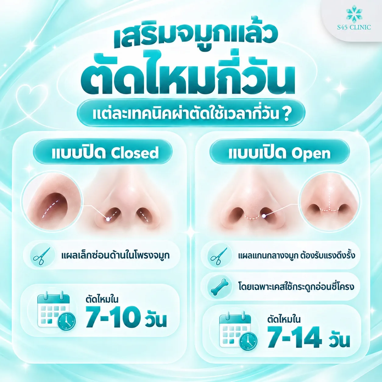 ระยะเวลาตัดไหมจมูก แบบปิดตัดไหมใน 7-10 วัน และแบบเปิดตัดไหมใน 7-14 วัน