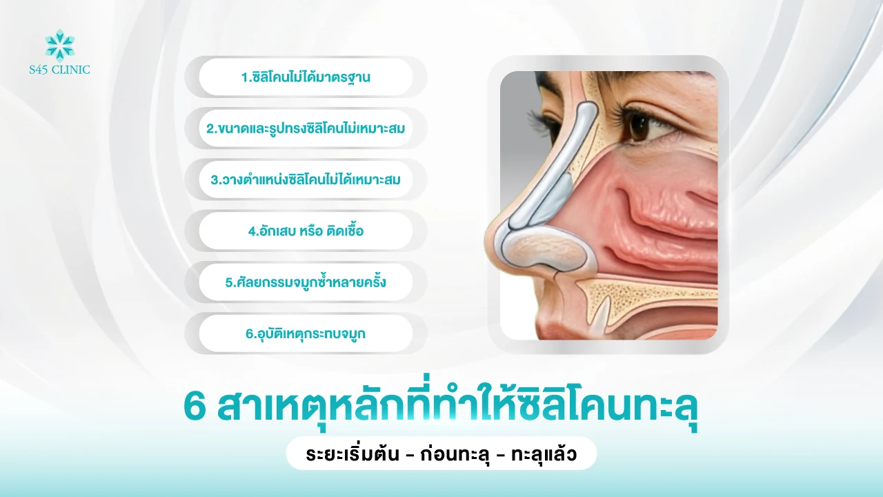6 สาเหตุหลักที่ทำให้ซิลิโคนจมูกทะลุ พร้อมภาพตัดขวางจมูกที่มีซิลิโคน