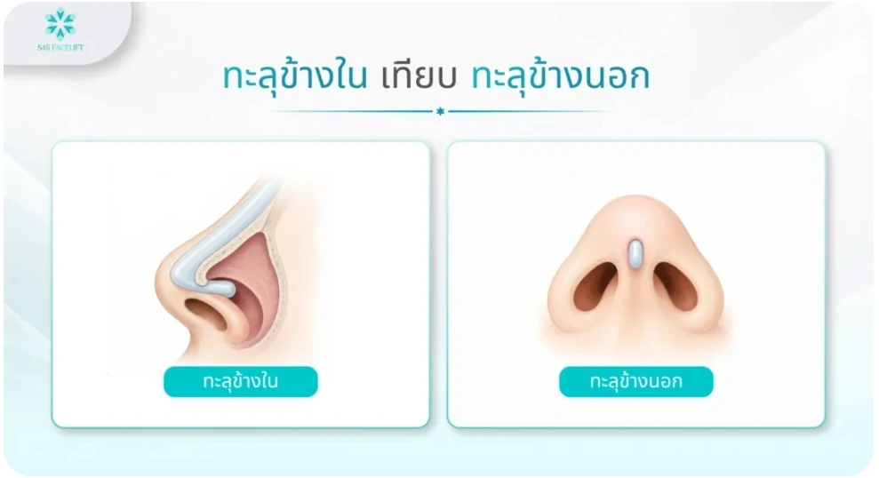 ภาพเปรียบเทียบซิลิโคนทะลุข้างในกับทะลุข้างนอก