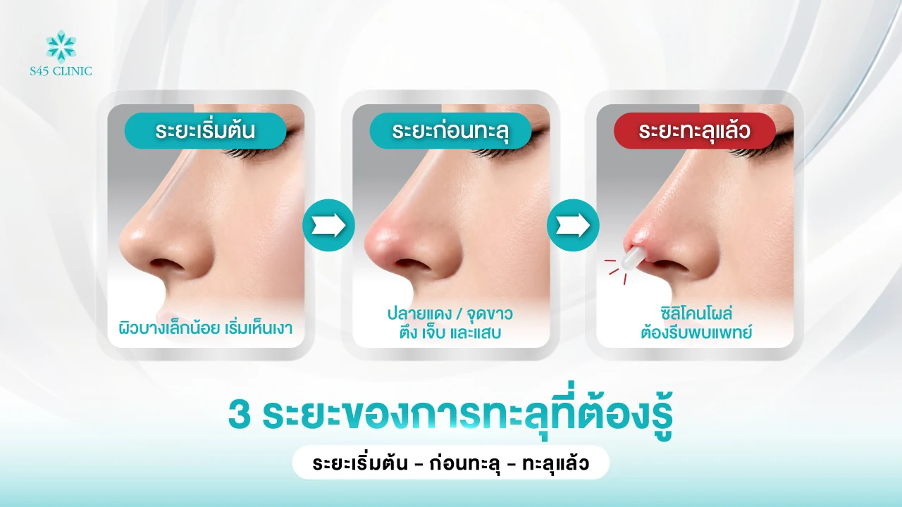 3 ระยะของซิลิโคนจมูกทะลุ ได้แก่ ระยะเริ่มต้น ระยะก่อนทะลุ และระยะทะลุแล้ว