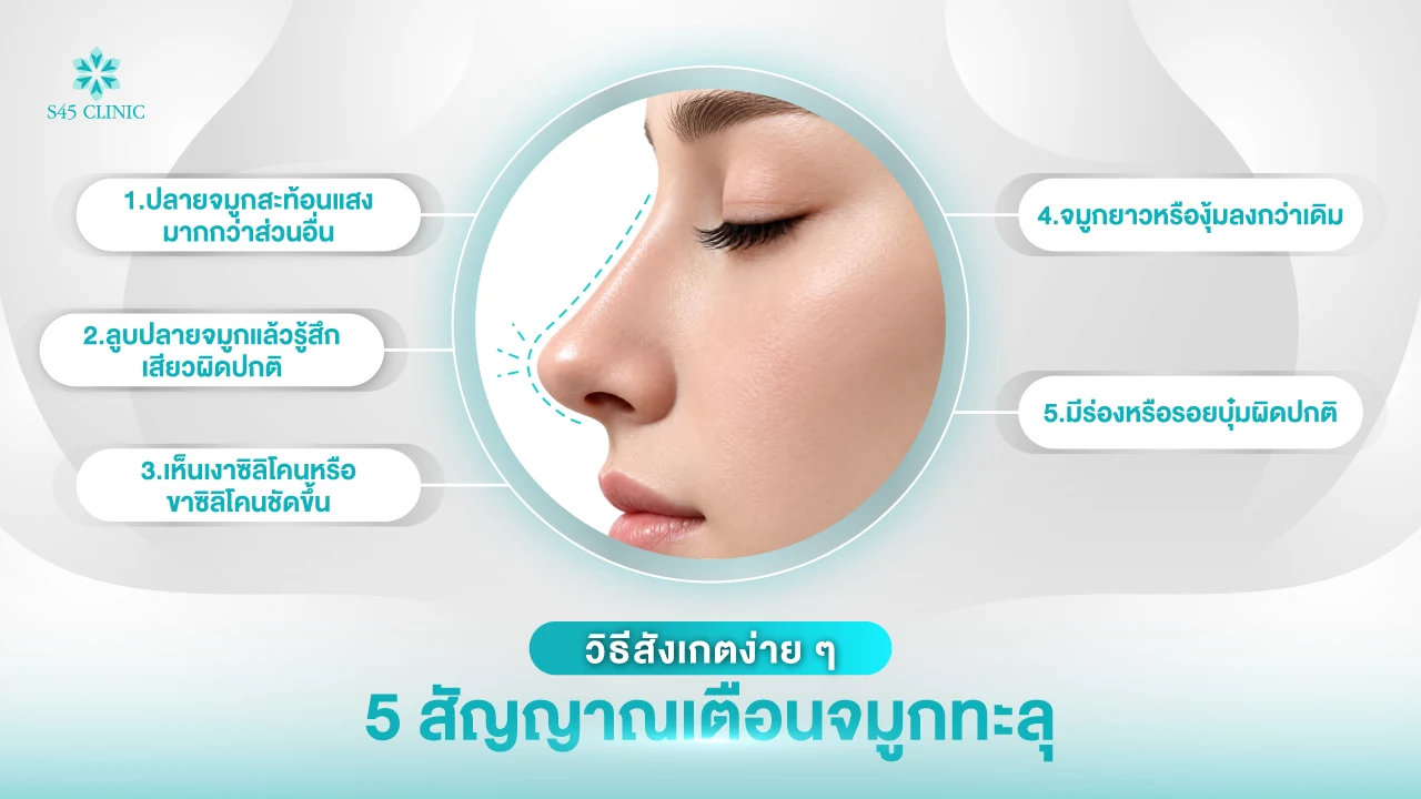 5 สัญญาณเตือนซิลิโคนจมูกทะลุ เช่น ปลายจมูกสะท้อนแสง และเห็นเงาซิลิโคนชัดขึ้น