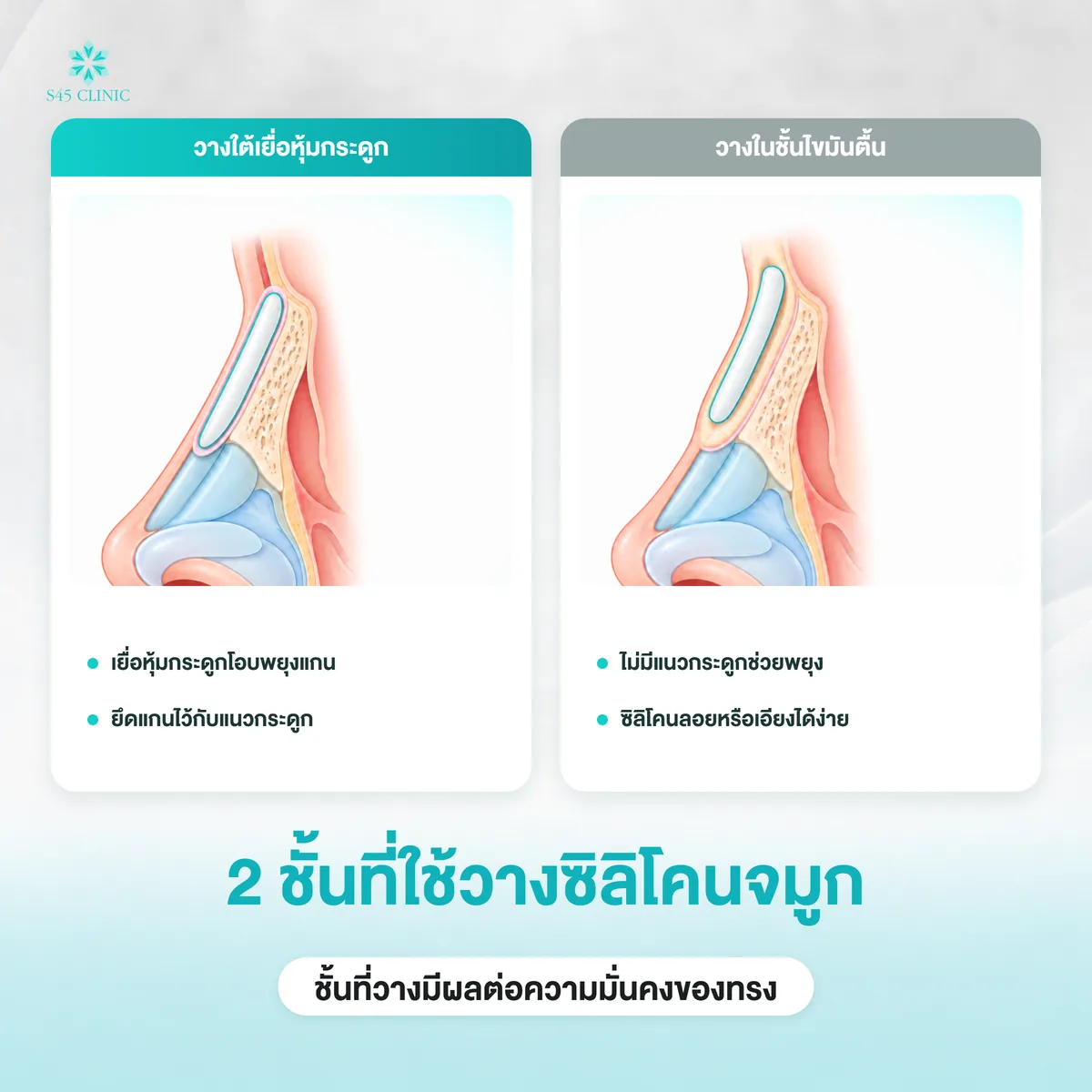 เปรียบเทียบการวางซิลิโคนจมูกใต้เยื่อหุ้มกระดูกกับการวางในชั้นไขมันตื้น