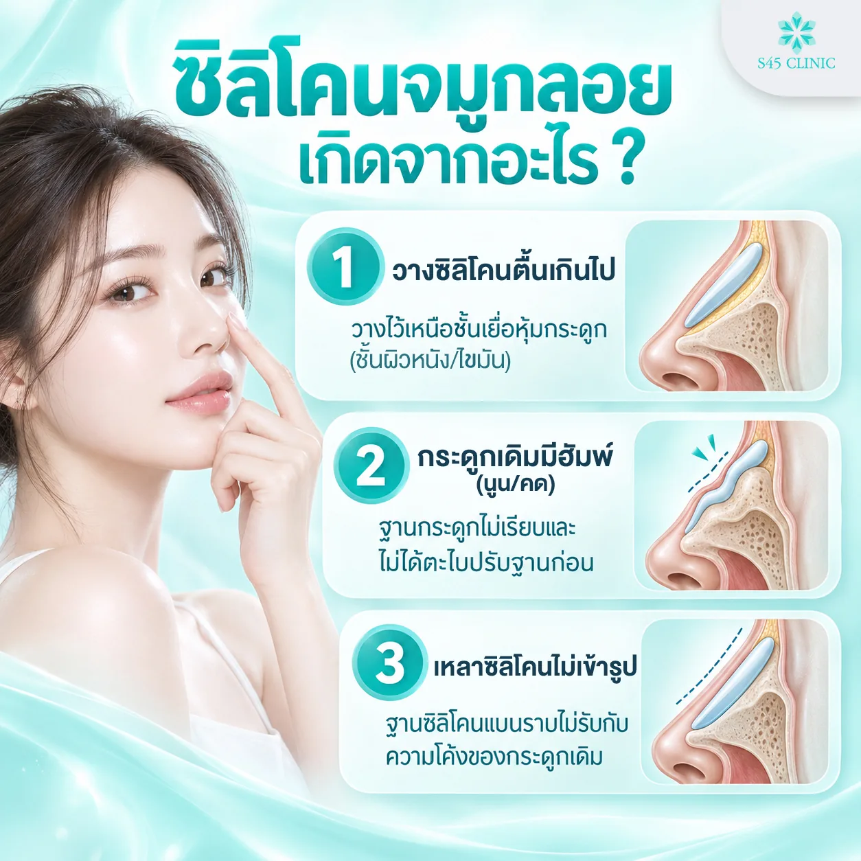 สาเหตุซิลิโคนจมูกลอย วางซิลิโคนตื้นเกินไป กระดูกเดิมมีฮัมพ์ และเหลาซิลิโคนไม่เข้ารูป