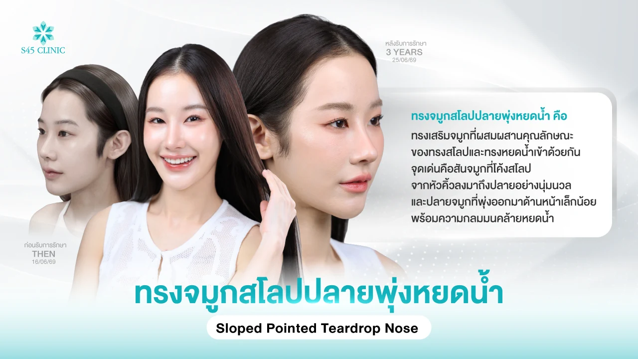 ภาพผู้รับบริการก่อนเสริมจมูกและหลังทำ 3 ปี ทรงจมูกสโลปปลายพุ่งหยดน้ำ