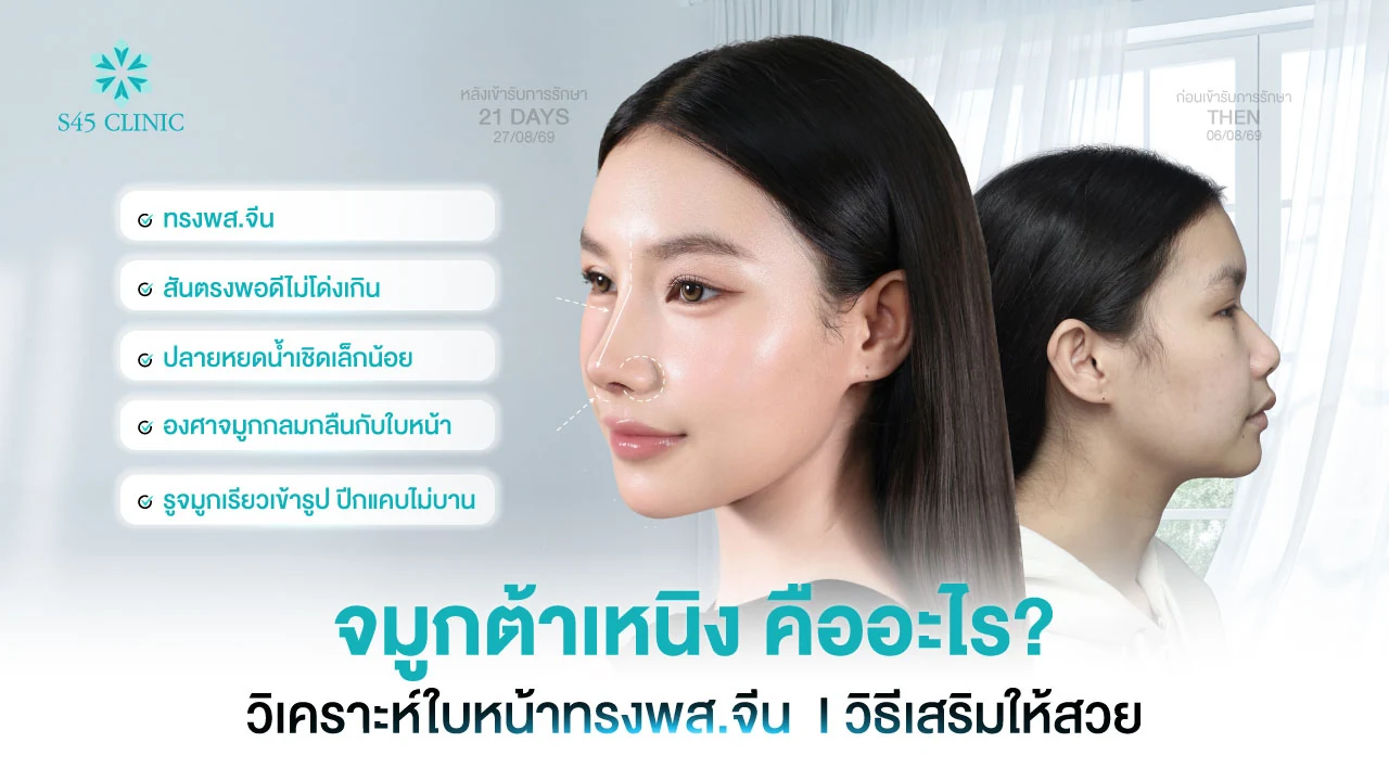 ภาพผู้รับบริการก่อนเสริมจมูกและหลังทำ 21 วัน ทรงจมูกต้าเหนิง