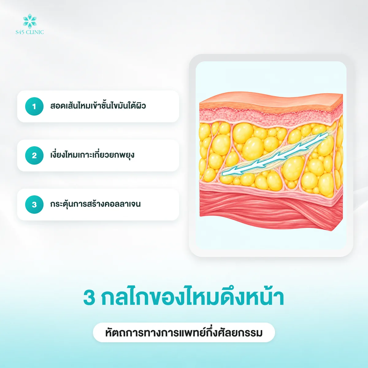 3 กลไกของไหมดึงหน้า สอดเส้นไหมเข้าชั้นไขมัน เงี่ยงไหมเกาะเกี่ยว และกระตุ้นคอลลาเจน