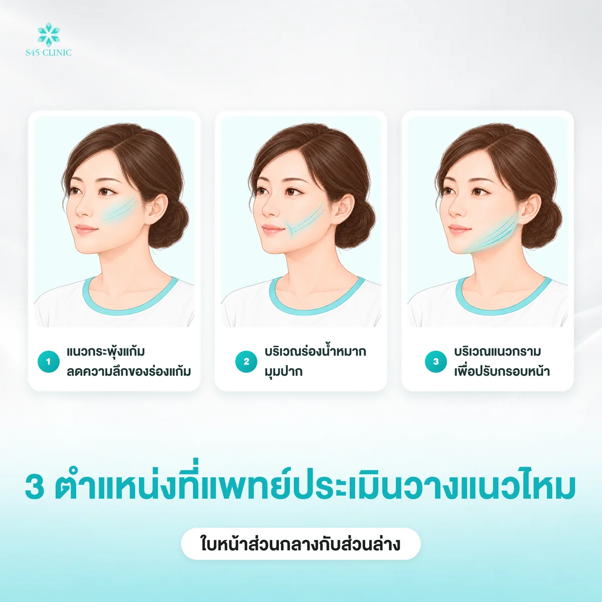 3 ตำแหน่งวางแนวไหม แนวกระพุ้งแก้ม ร่องน้ำหมากมุมปาก และแนวกราม
