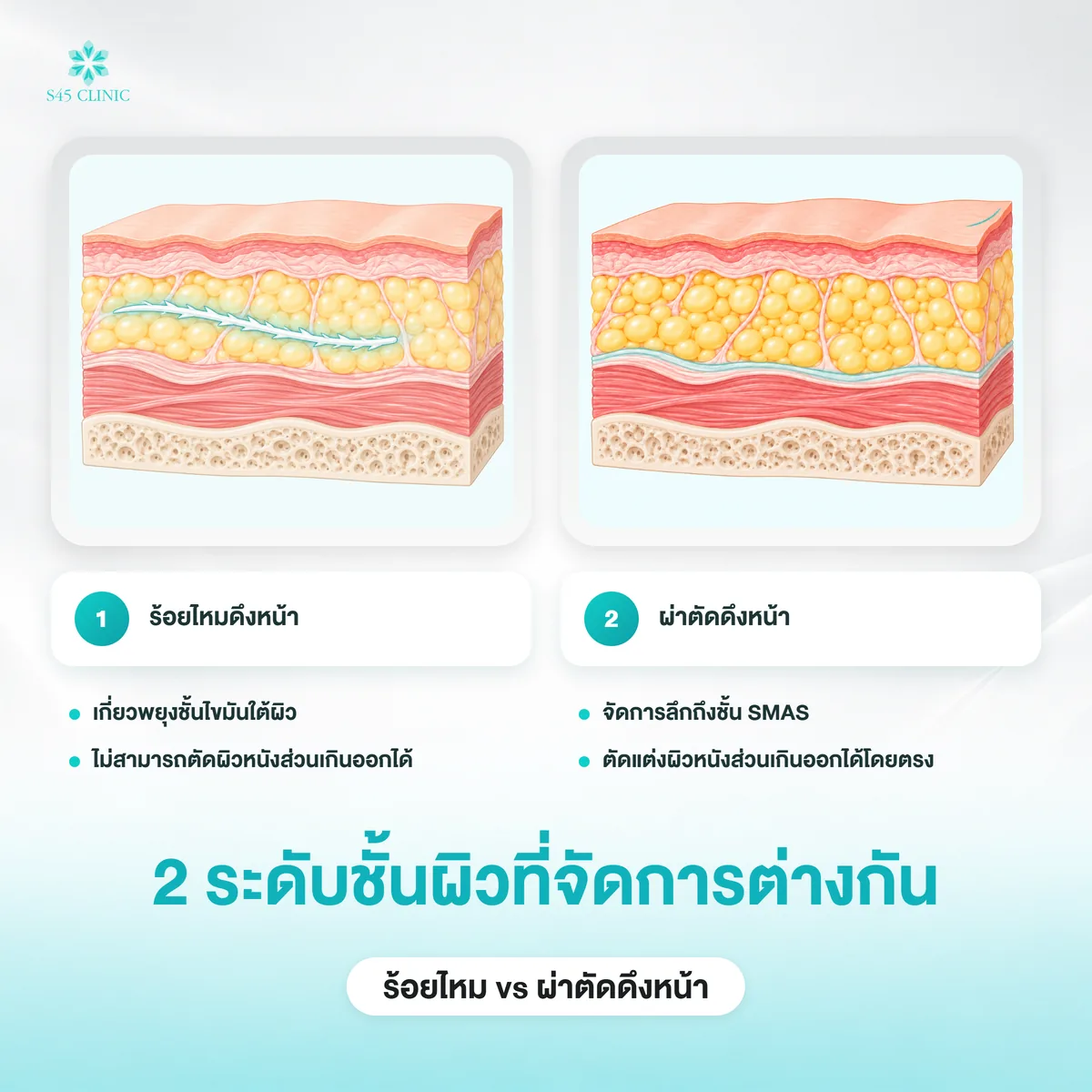 เปรียบเทียบชั้นผิวที่ร้อยไหมดึงหน้ากับผ่าตัดดึงหน้าจัดการ ตั้งแต่ชั้นไขมันถึงชั้น SMAS