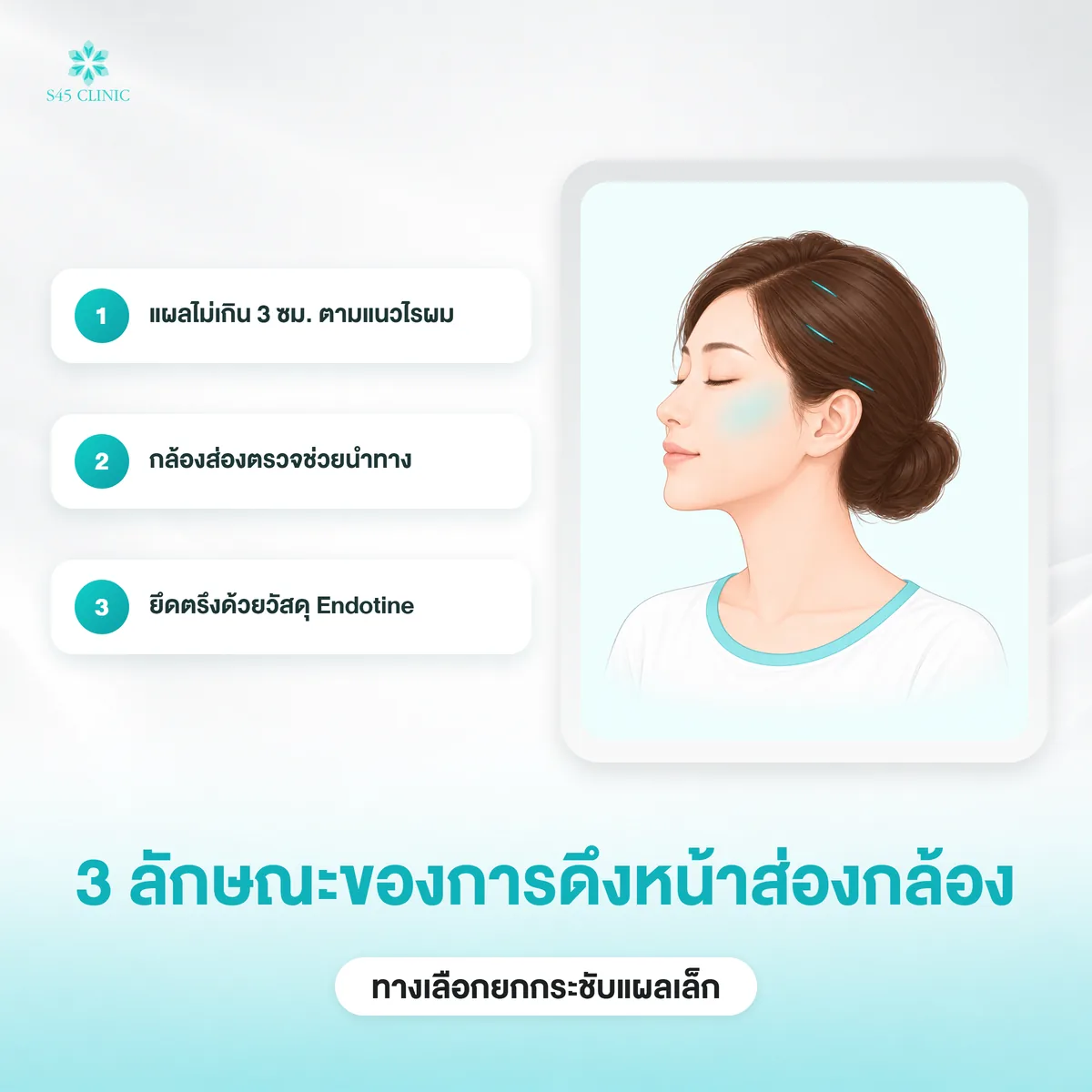3 ลักษณะของการดึงหน้าส่องกล้อง แผลไม่เกิน 3 ซม. ในแนวไรผม กล้องนำทาง และยึดด้วย Endotine