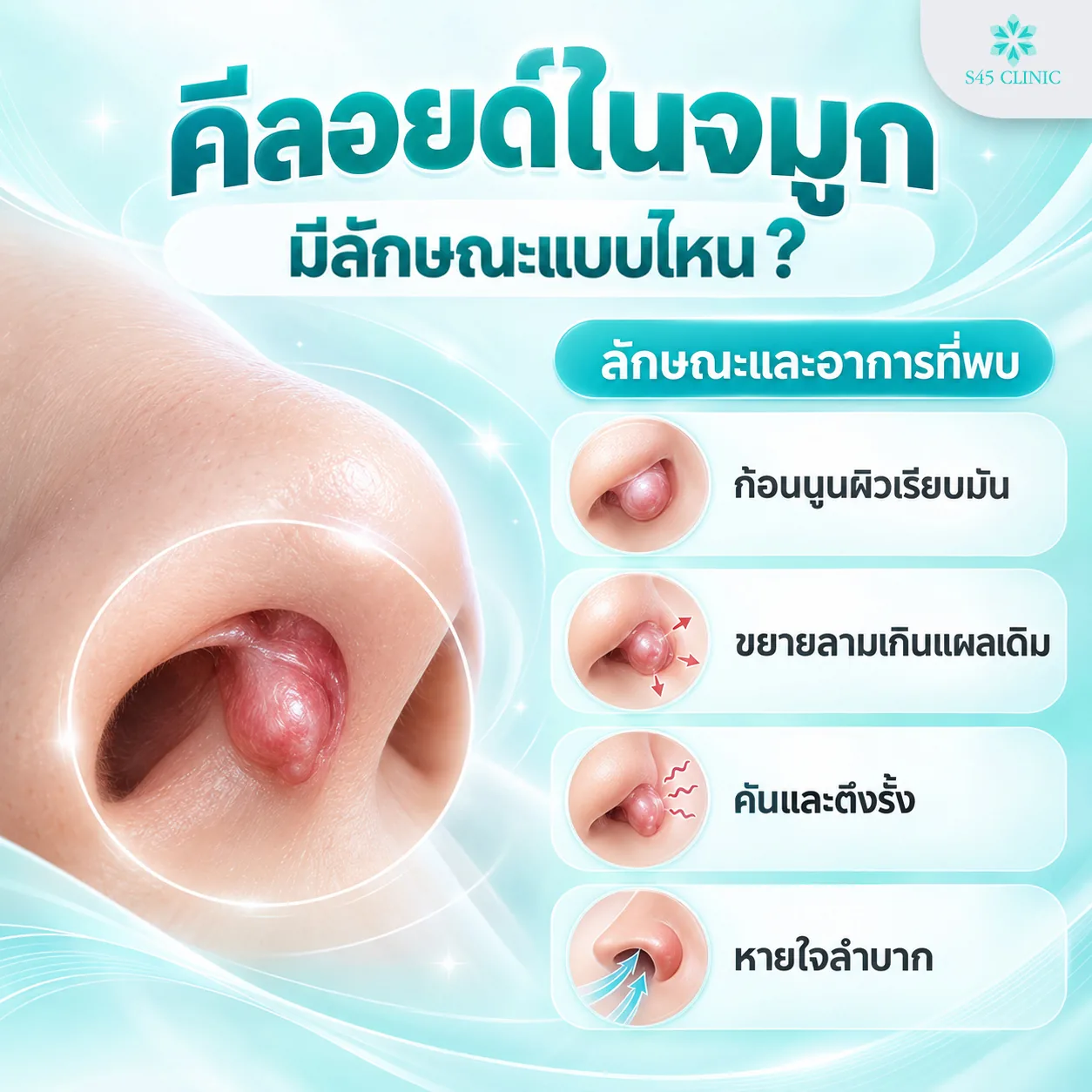 ลักษณะคีลอยด์ในจมูก ก้อนนูนผิวเรียบมัน ขยายลามเกินแผลเดิม คันตึงรั้ง และหายใจลำบาก