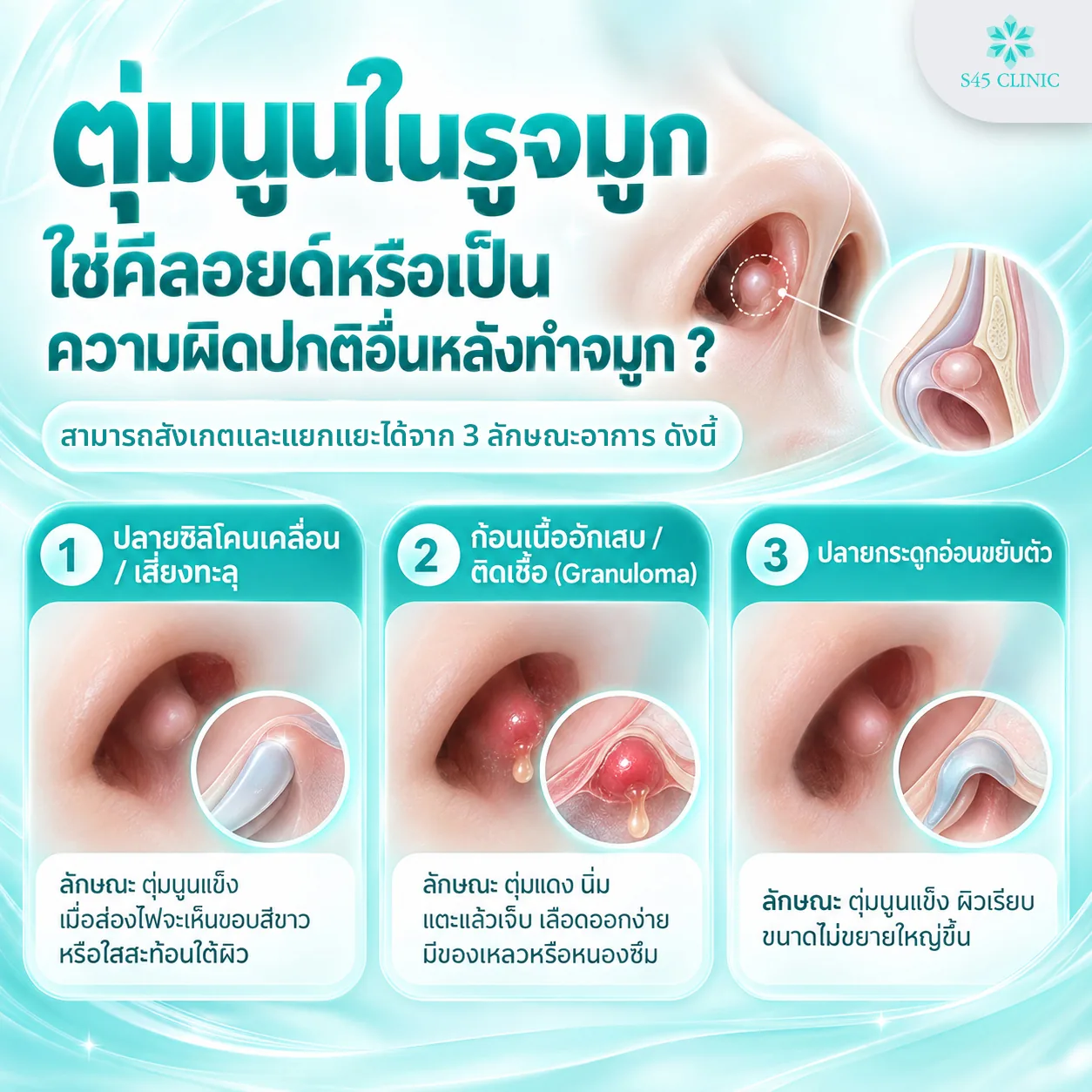 ตุ่มนูนในรูจมูกที่ไม่ใช่คีลอยด์ ปลายซิลิโคนเคลื่อน ก้อนเนื้ออักเสบ และปลายกระดูกอ่อนขยับตัว